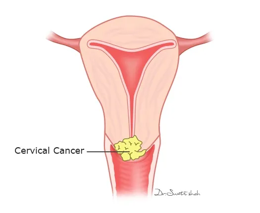 Stage-1 Cervical Cancer
