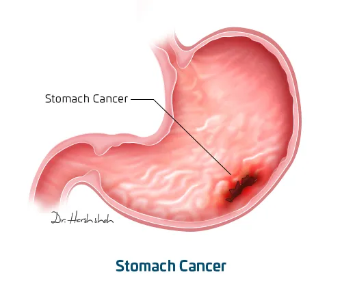 Stomach-cancer