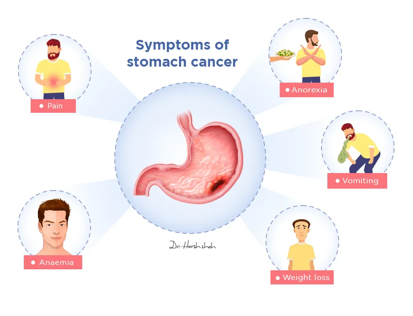 Symptoms-of-stomach-cancer