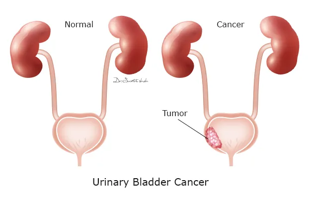 Urinary-Bladder-Cancer