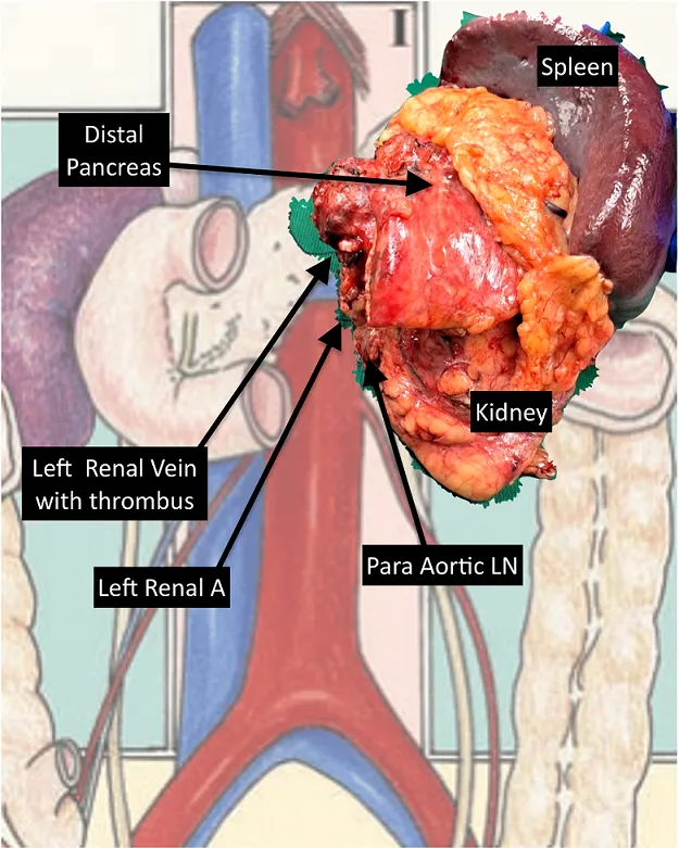 Extended Resection for Recurrent Adrenal Cancer