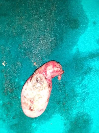 Gall Bladder 1