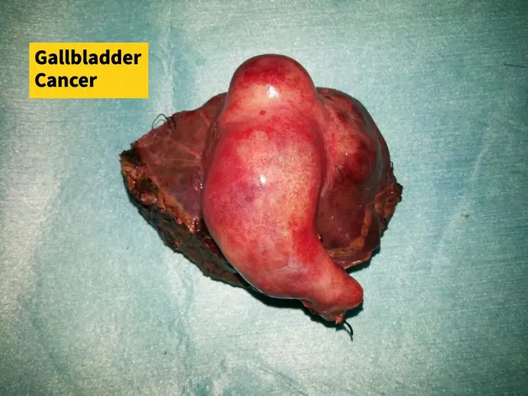 Gallbladder cancer specialist in Ahmedabad