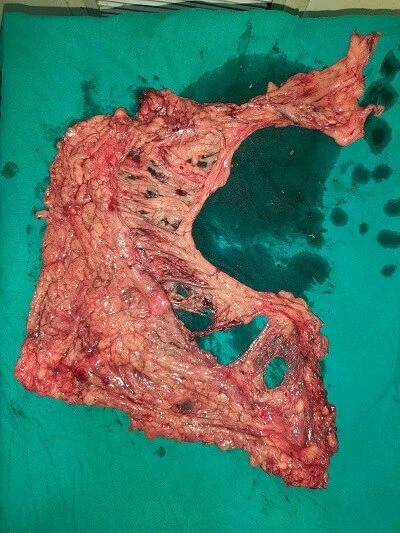 Greater Omentum 1