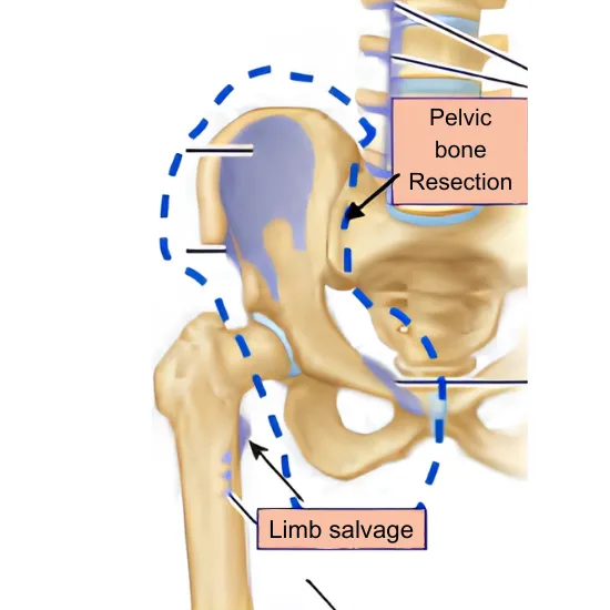 Internal - Hemipelvectomy