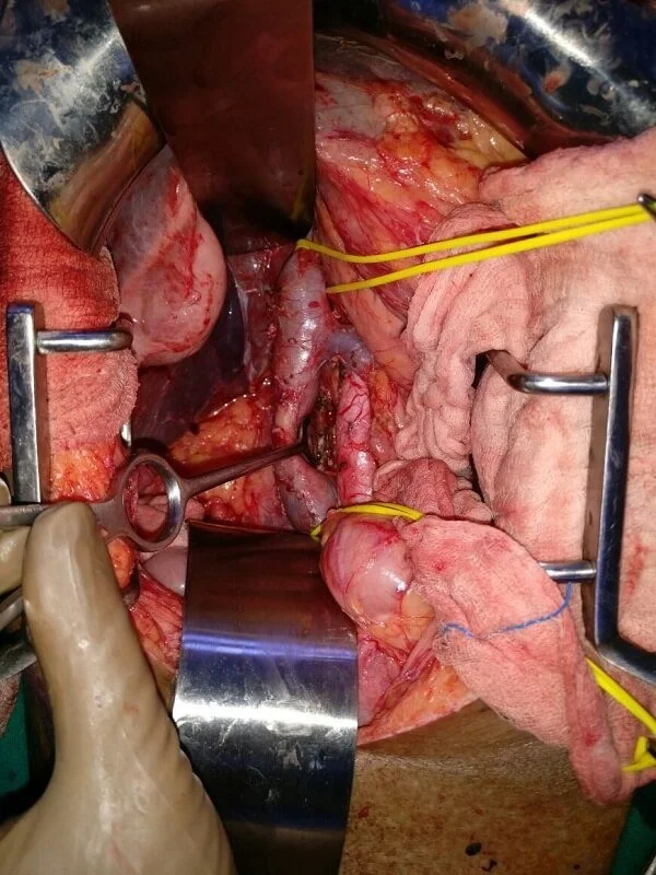 Kidney-Cancer Radical Nephrectomy and Para Aortic LN Dissection