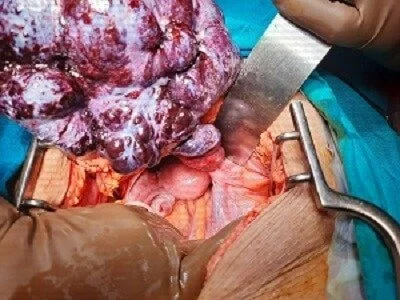 Large Ovarian Tumour with Torsion #1