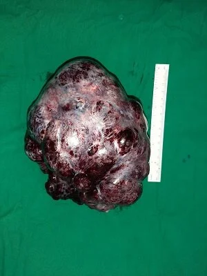 Large Ovarian Tumour with Torsion #3