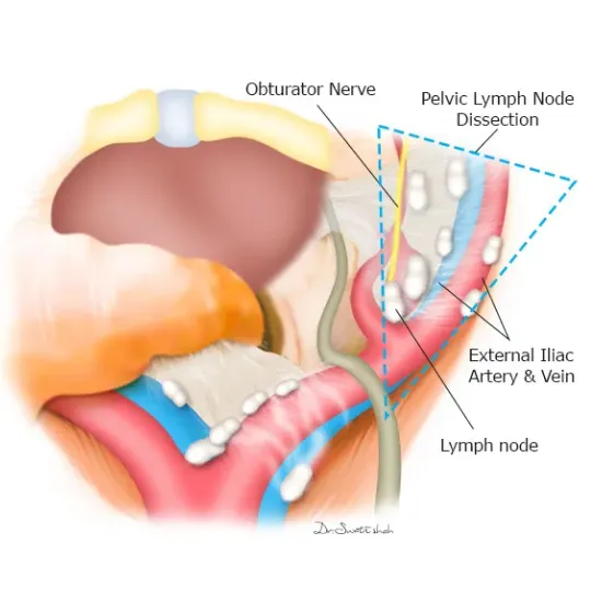 Pelvic-Lymph-Node-Dissection