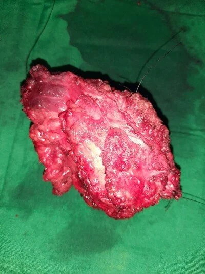 Pelvic tumour 1