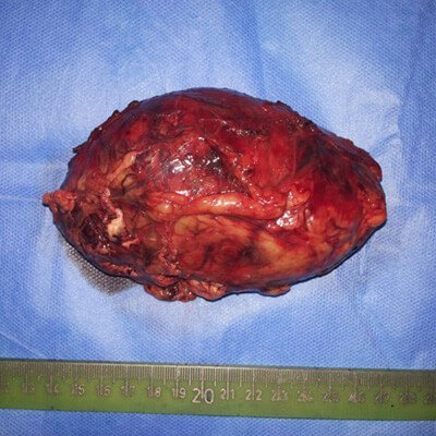 Pheochromocytoma thumb