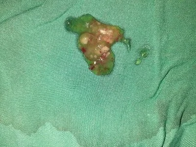 Pseudomyxoma– gelatin like fluid