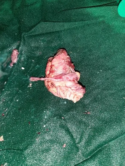 Resected Small bowel