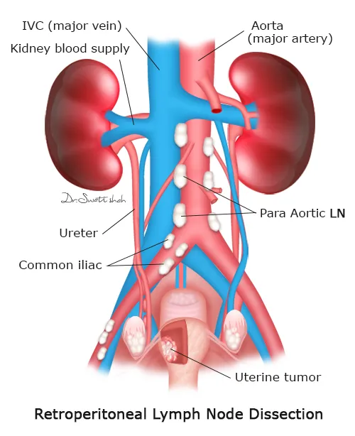 Retroperitoneal-LND