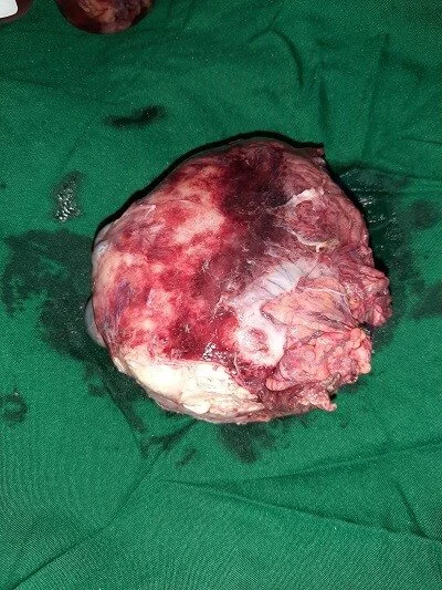 Right Ovarian Mass 1