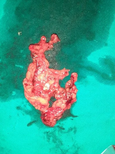 Right pelvic LN 1