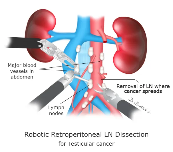 Robotic-Retroperitoneal-LN-Dissection2