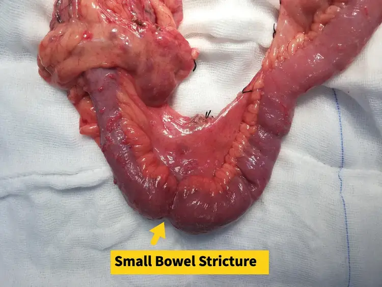 Small bowel stricture specialist in Ahmedabd India