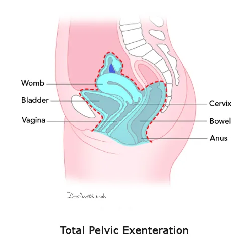 Total-Pelvic-Exenteration