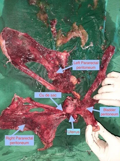 Uterus with Left SO with Pelvic Peritonectomy with Cul desectomy