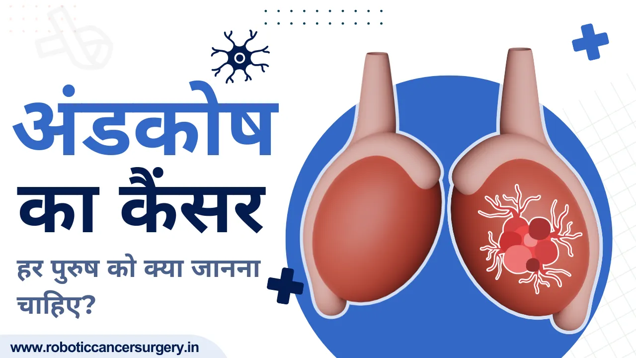 अंडकोष का कैंसर (Testicular Cancer): जोखिम कारक, जांच और इलाज