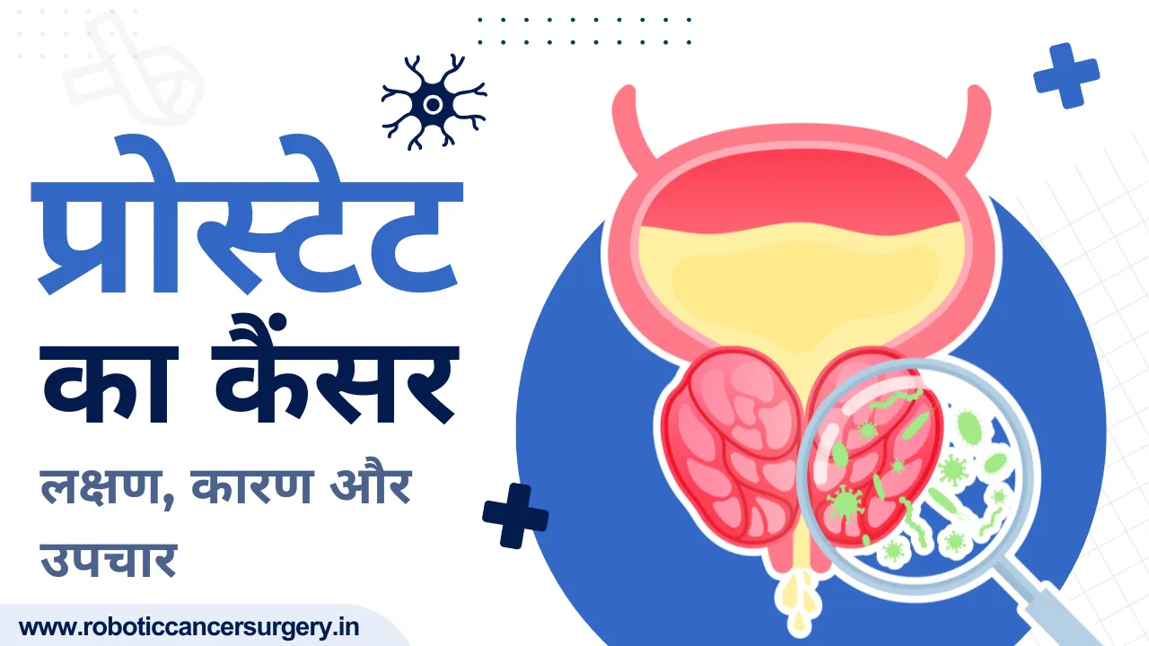 पुरुषों में प्रोस्टेट कैंसर: शुरुआती लक्षण, कारण और उपचार