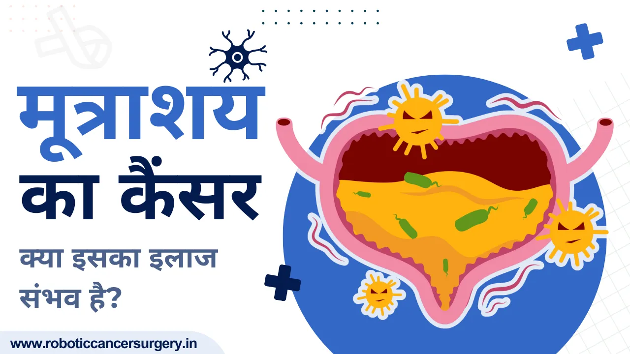 मूत्राशय कैंसर: क्या इसका इलाज संभव है?