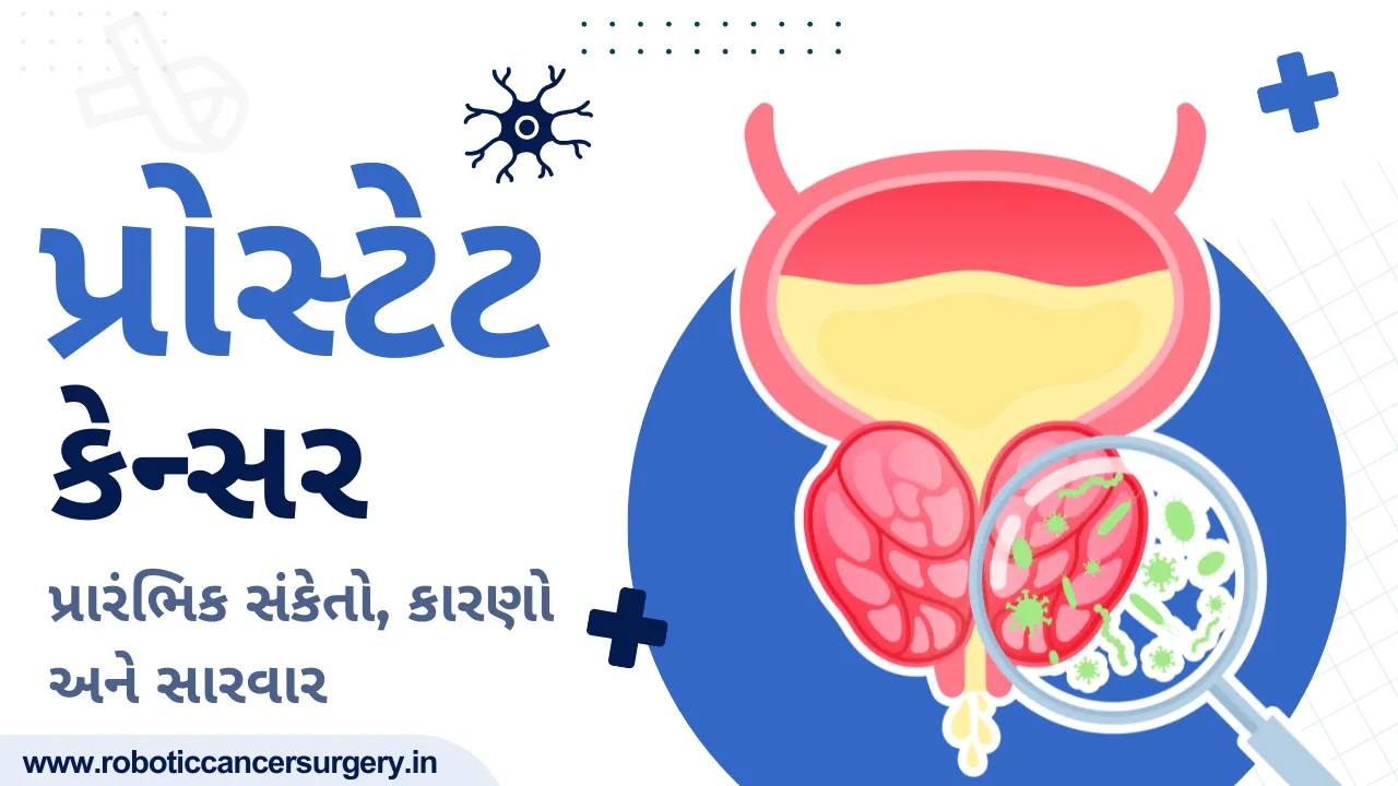 પુરુષોમાં પ્રોસ્ટેટ કેન્સર: પ્રારંભિક સંકેતો, કારણો અને સારવાર