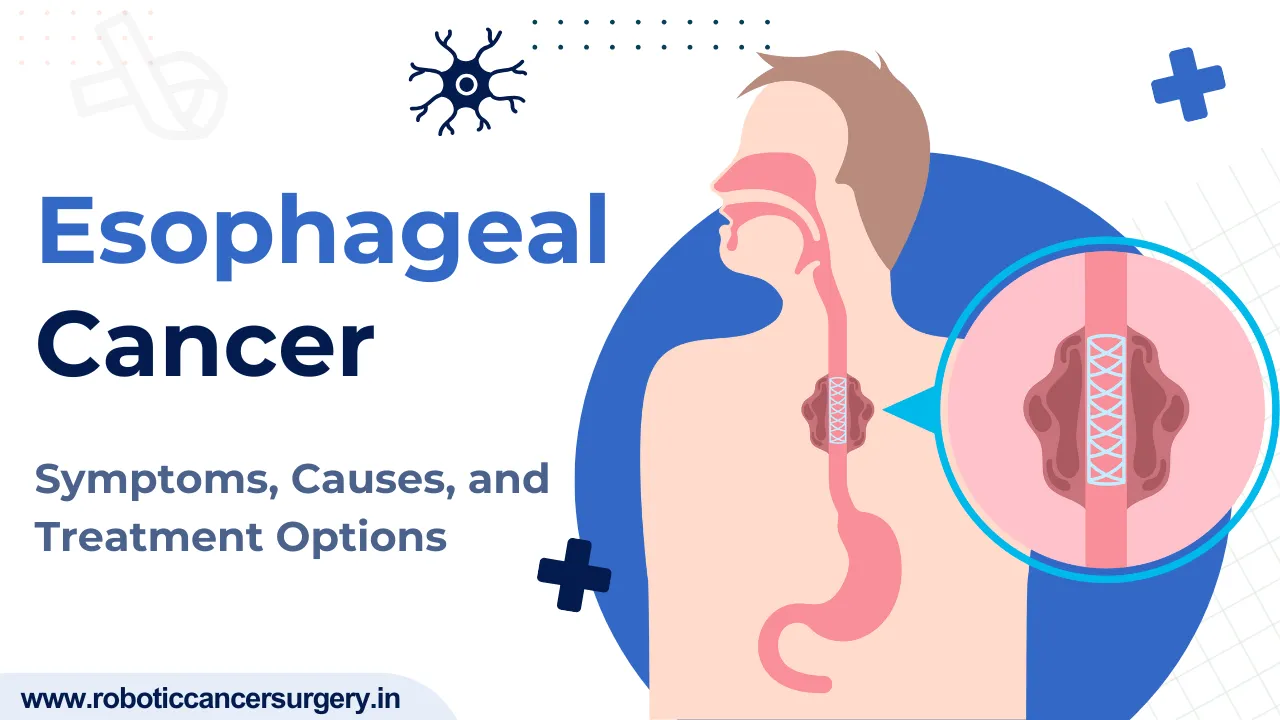 Esophageal Cancer: Symptoms, Causes, and Treatment Options