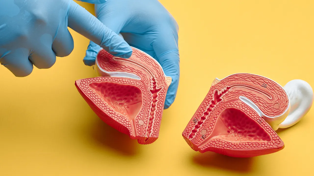 Partial Cystectomy