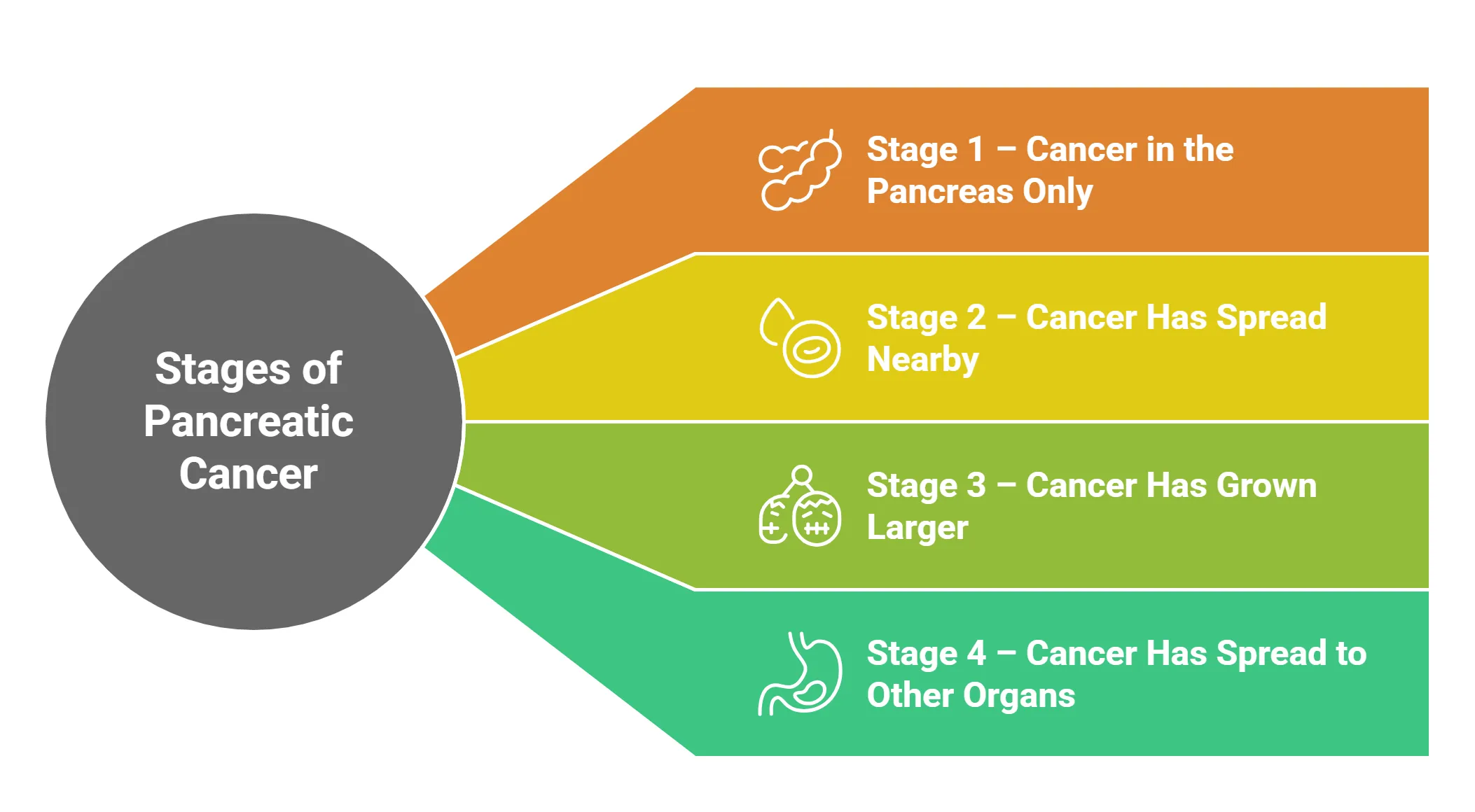 Stages of Pancreatic Cancer