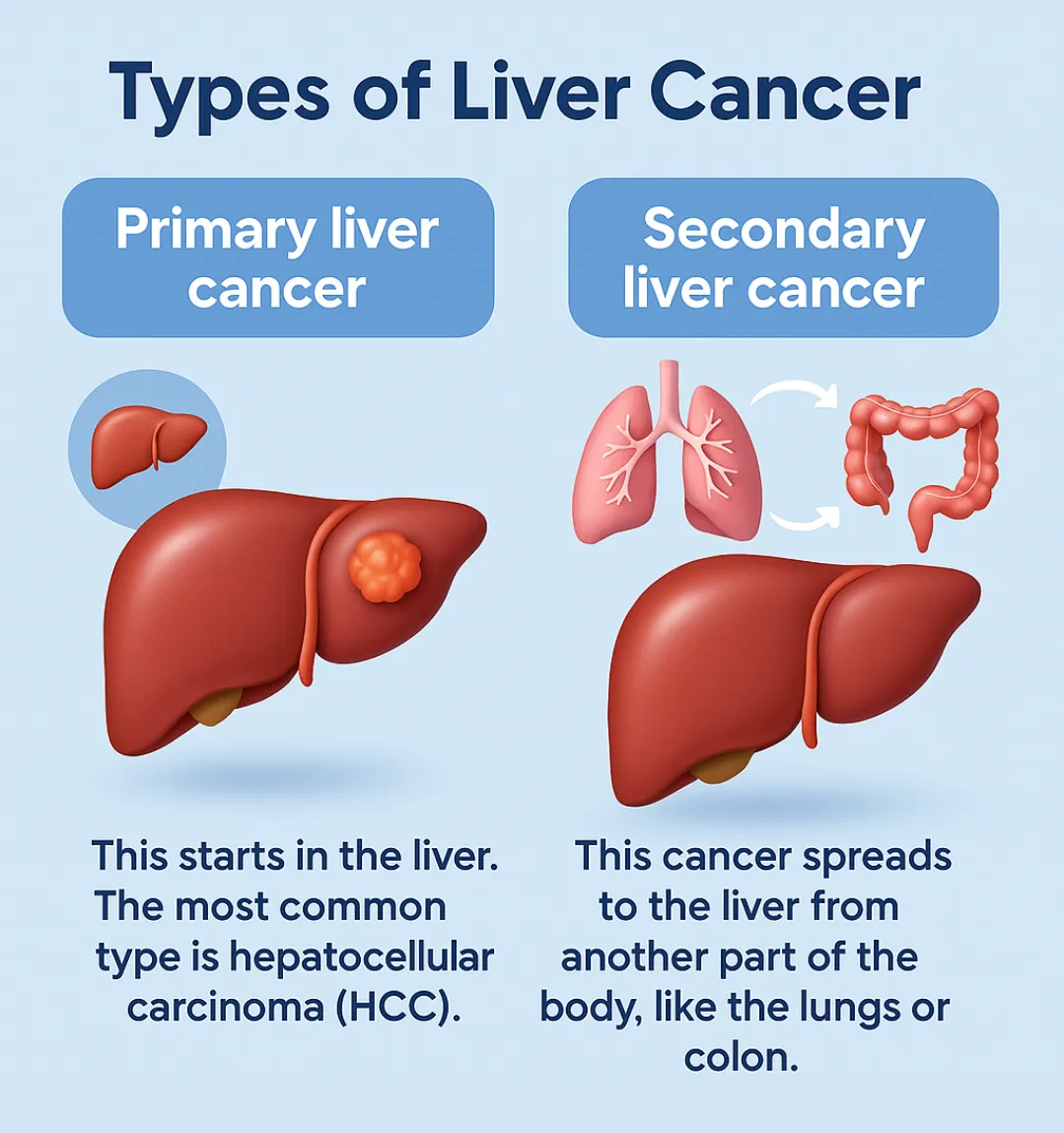Types of Liver Cancer