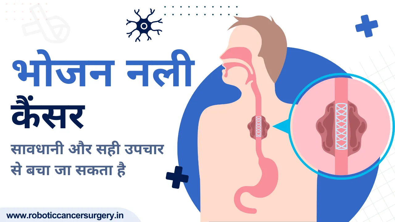 भोजन नली का कैंसर: लक्षण, कारण और उपचार