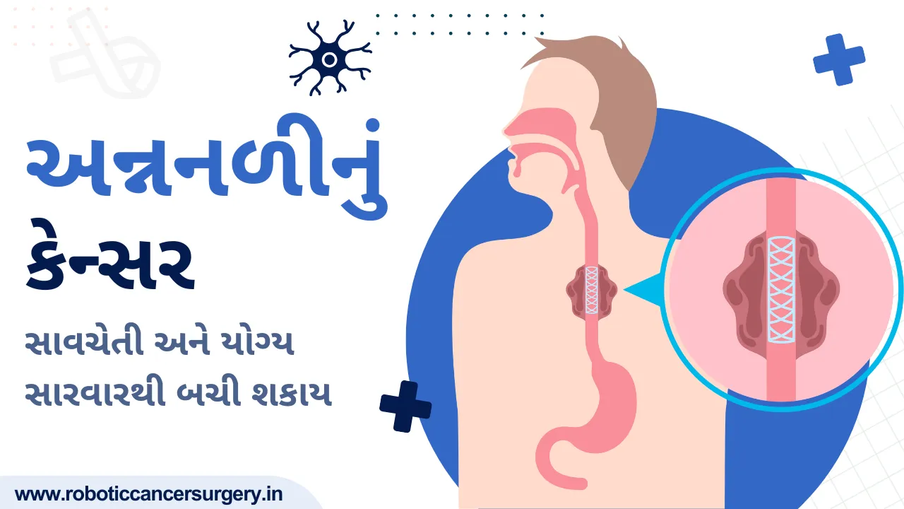 અન્નનળીનું કેન્સર: લક્ષણો, કારણો, નિદાન અને સારવાર